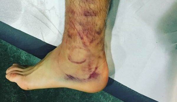 Imagen que Luis Albertó colgó en Instagram de su tobillo